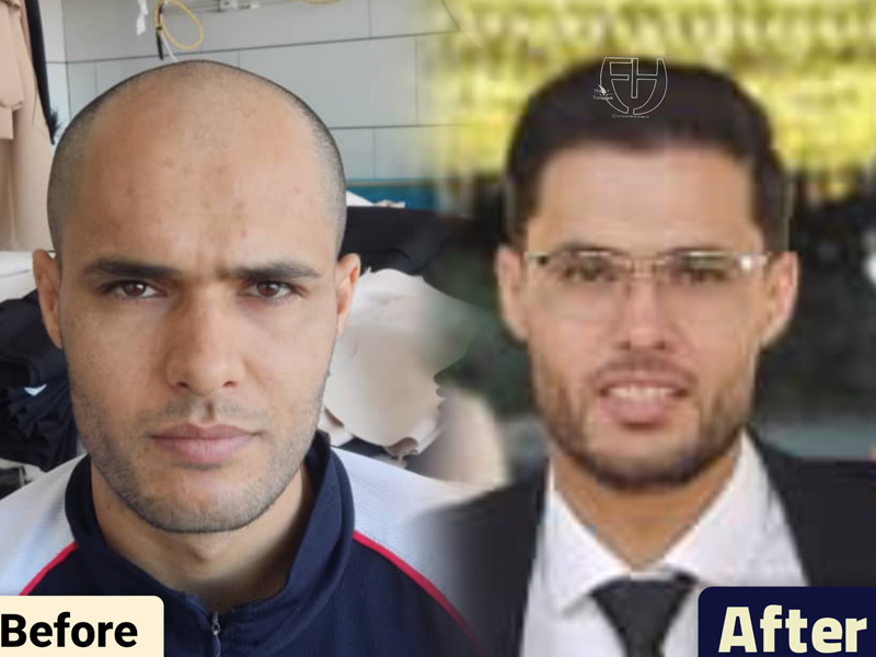 کاشت مو به روش fit