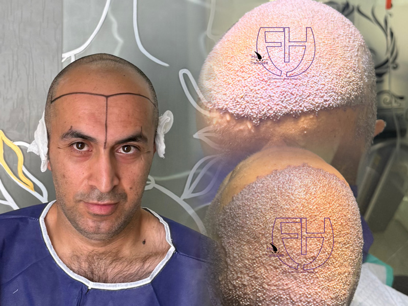 کاشت مو به روش fit