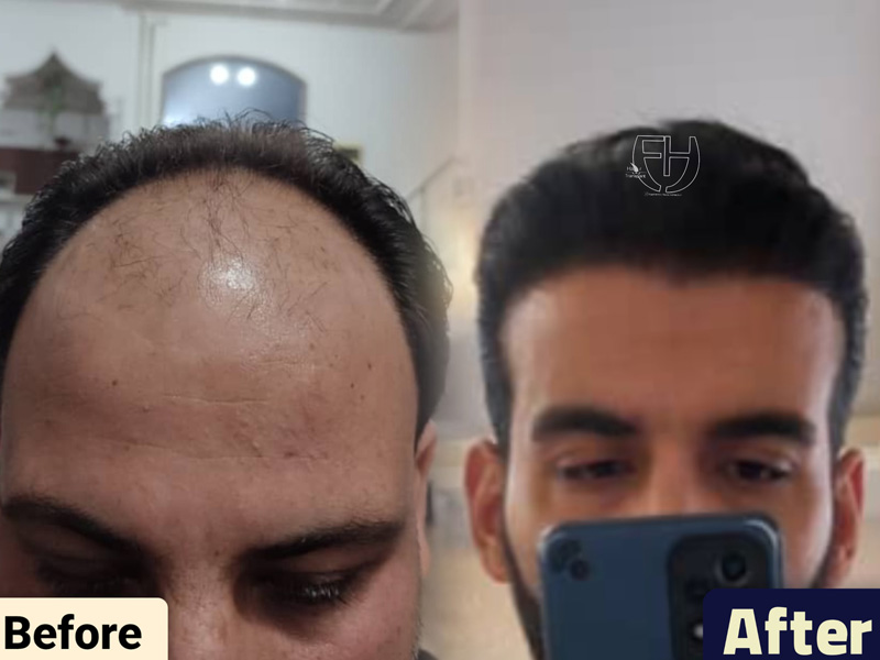 کاشت مو به روش fit