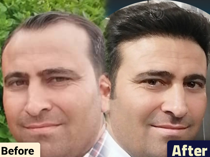 کاشت مو به روش fit