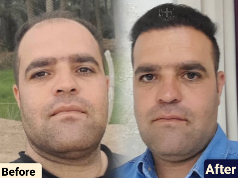 کاشت مو به روش fit و sut