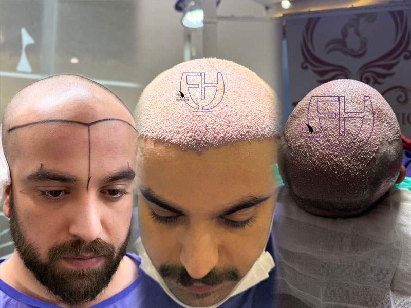 کاشت مو به روش fit