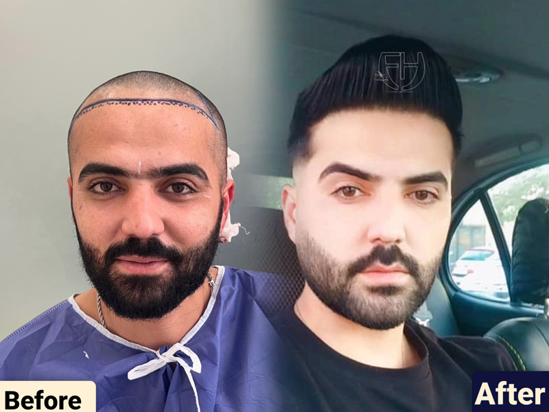 کاشت مو به روش fit