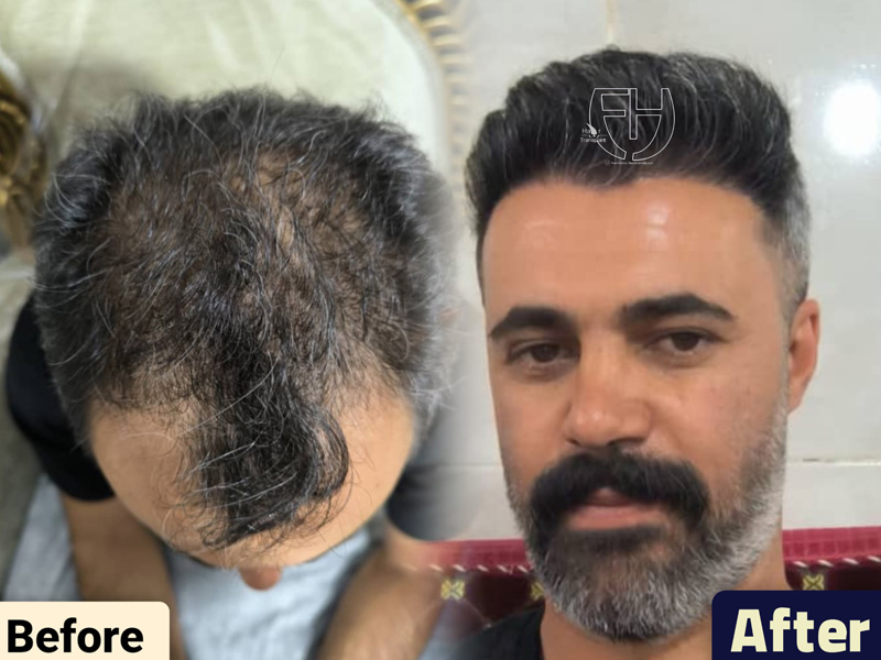 کاشت مو به روش fit و sut
