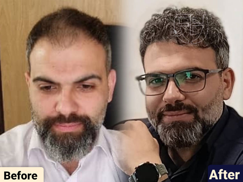 کاشت مو به روش fit و sut