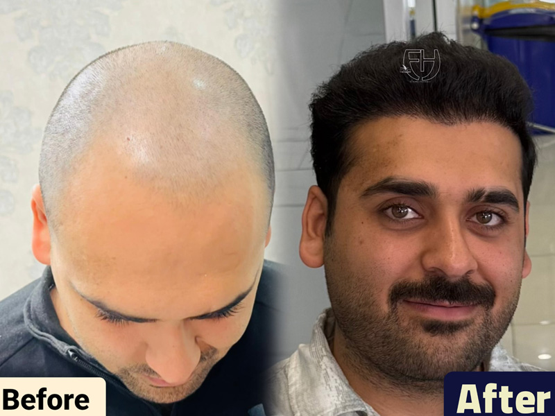 کاشت مو به روش fit