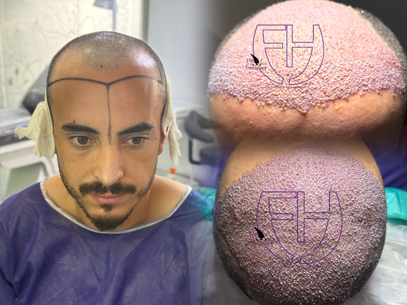 کاشت مو به روش fit و sut