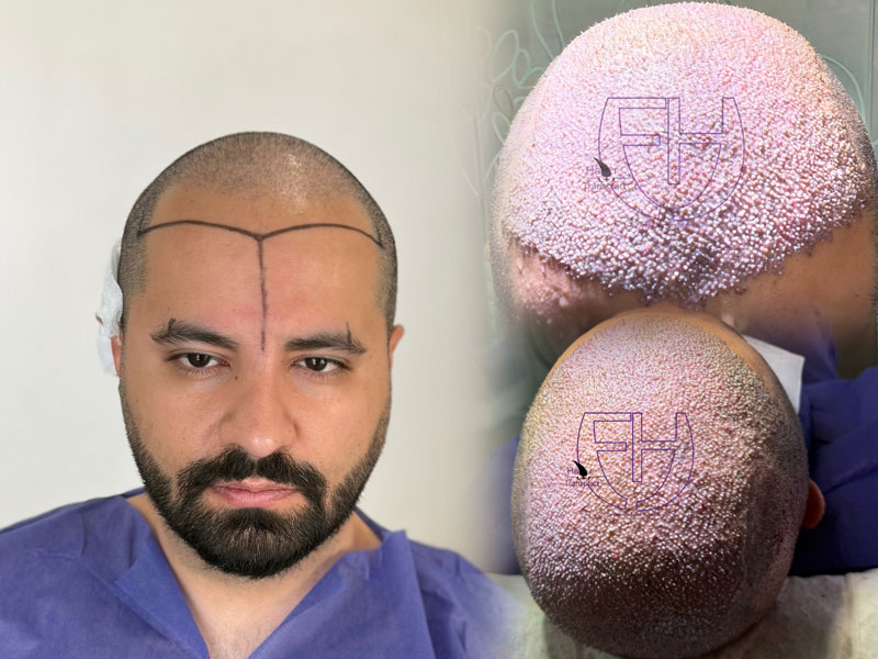 کاشت مو به روش fit