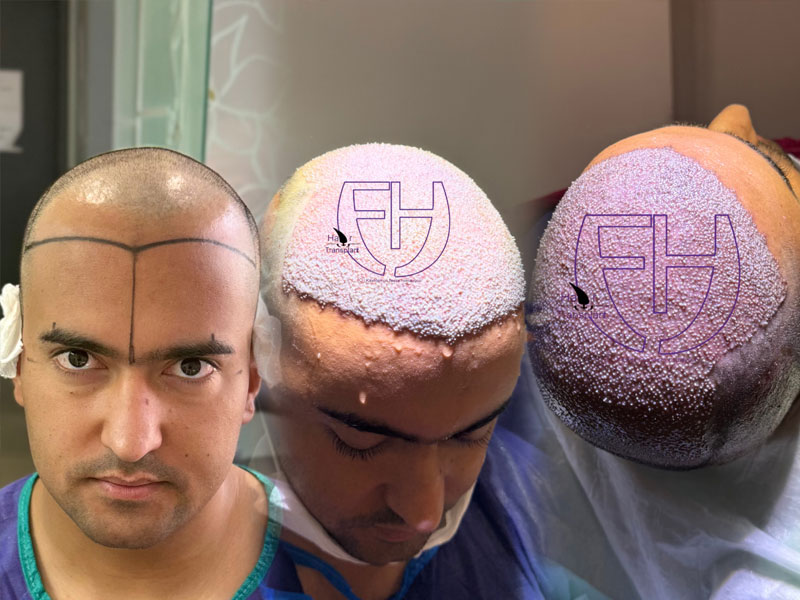 کاشت مو به روش fit و sut