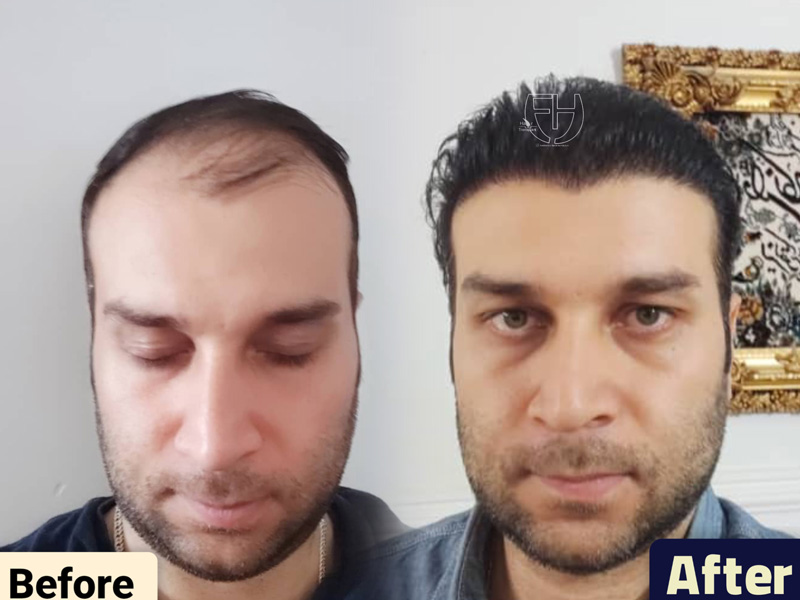 کاشت مو به روش fit و sut