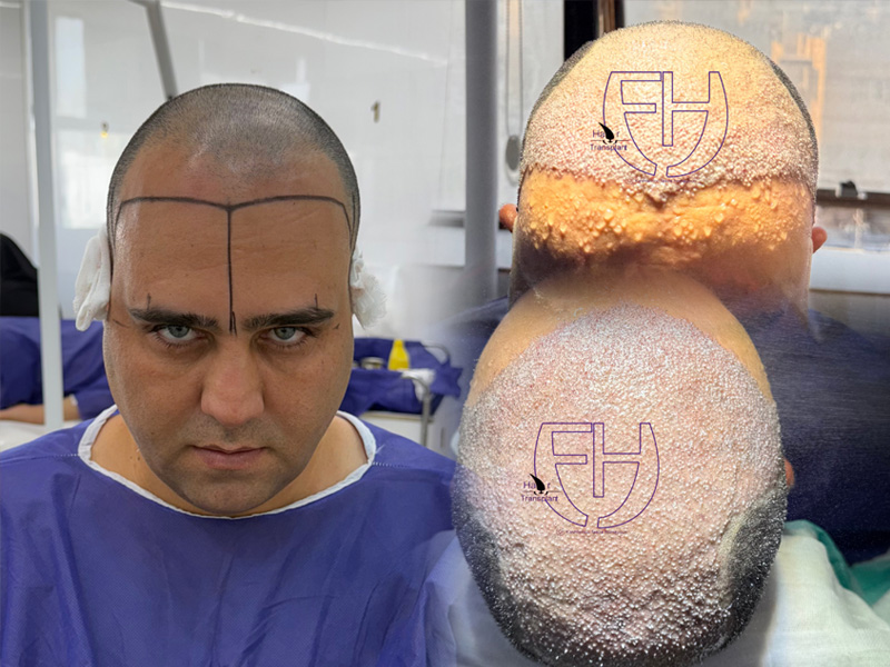 کاشت مو به روش fit