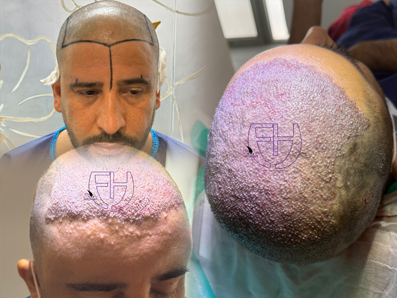 کاشت مو به روش fit و sut