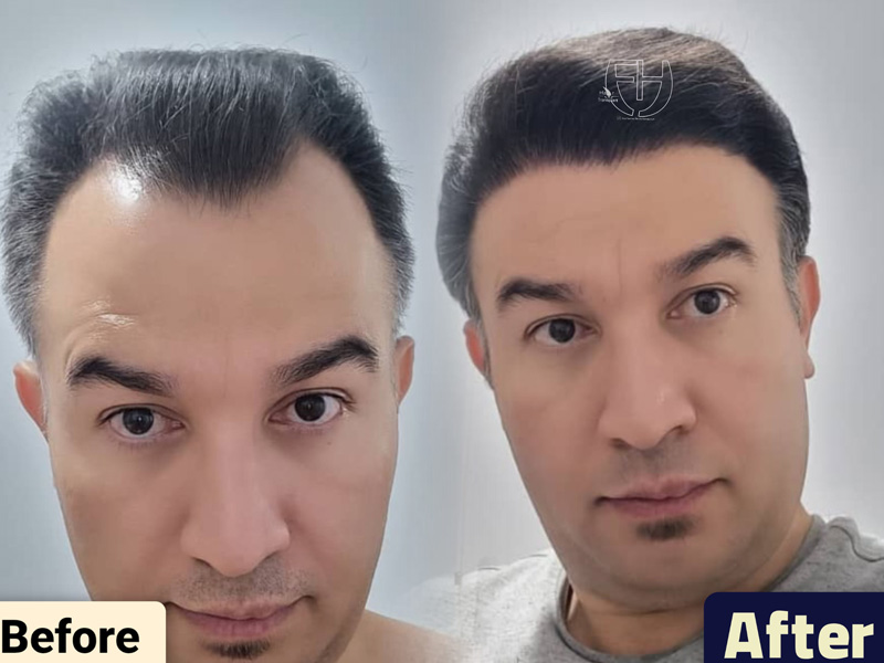 کاشت مو به روش fit و sut