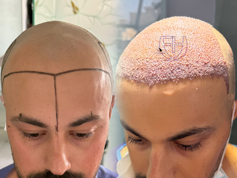 کاشت مو به روش fit و sut