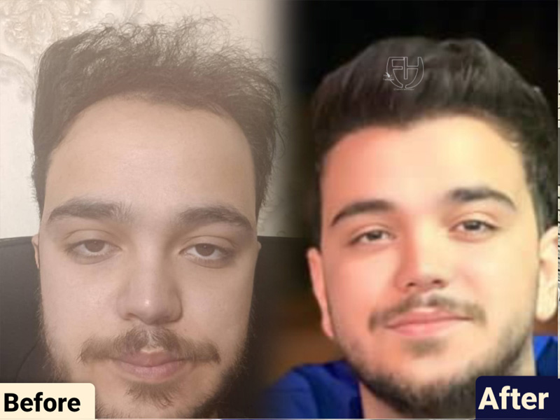 کاشت مو به روش fit و sut