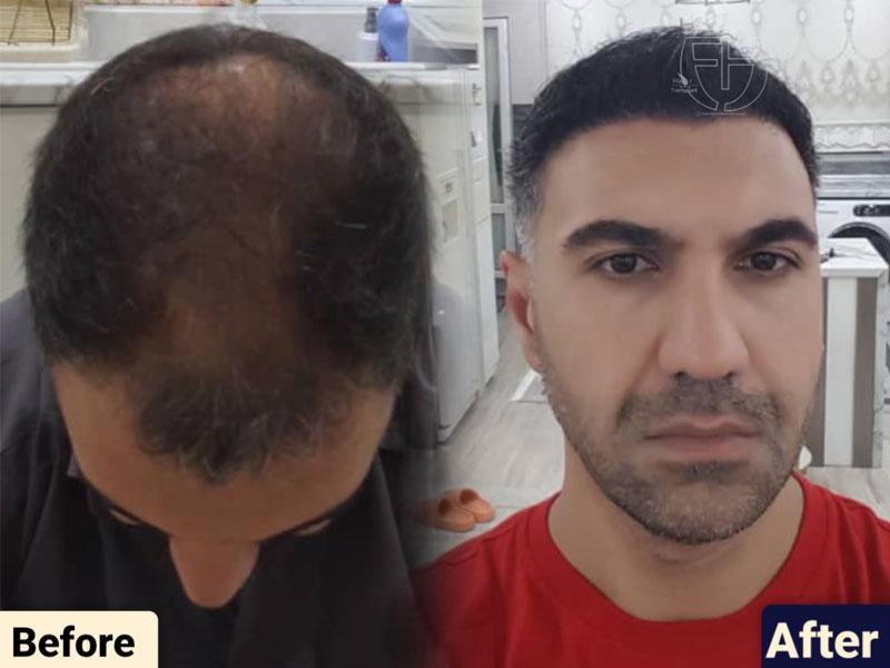 کاشت مو به روش fit و sut