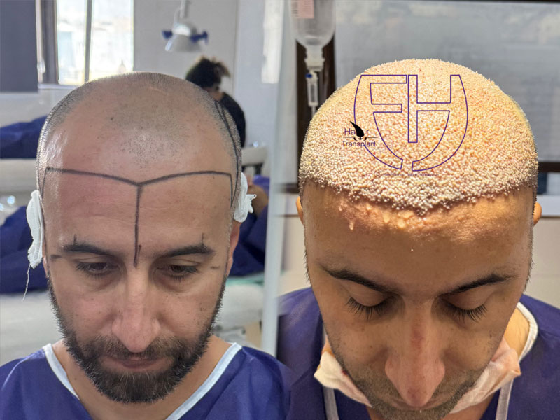 کاشت مو به روش fit