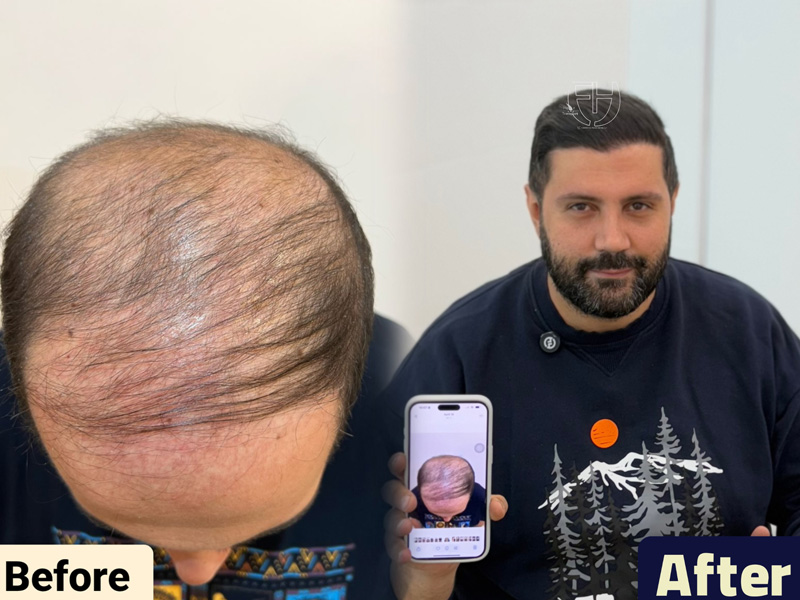 کاشت مو به روش fit