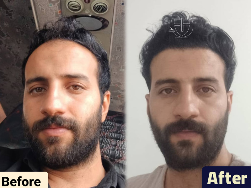 کاشت مو به روش fit و sut