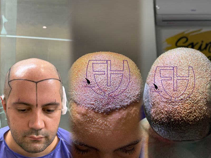 کاشت مو به روش fit