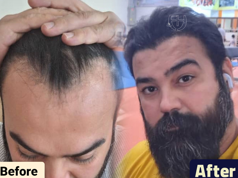 کاشت مو به روش fit