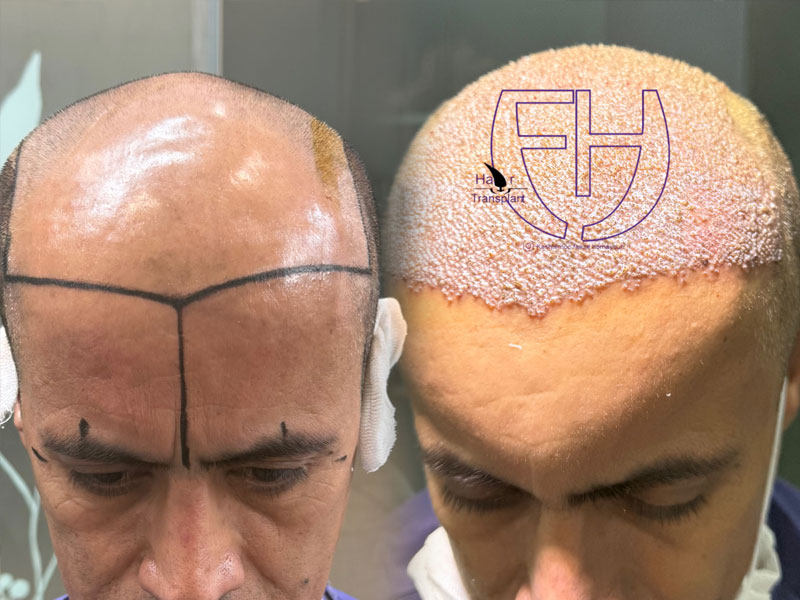 کاشت مو به روش fit و sut