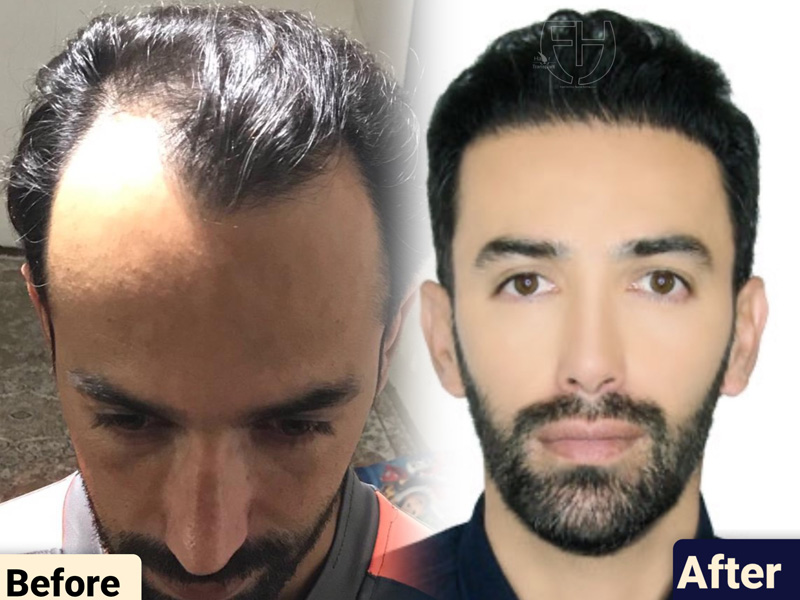 کاشت مو به روش fit و sut