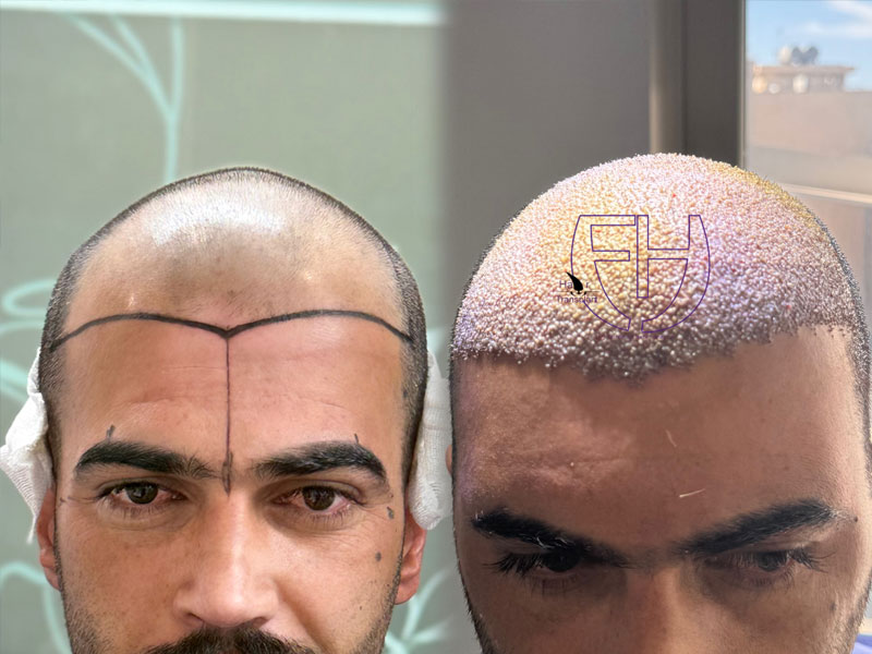 کاشت مو به روش fit