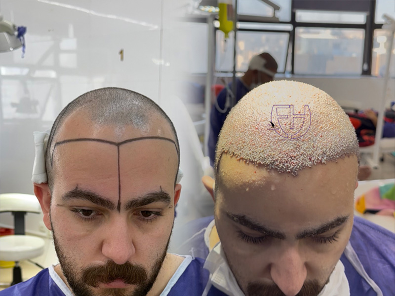 کاشت مو به روش fit