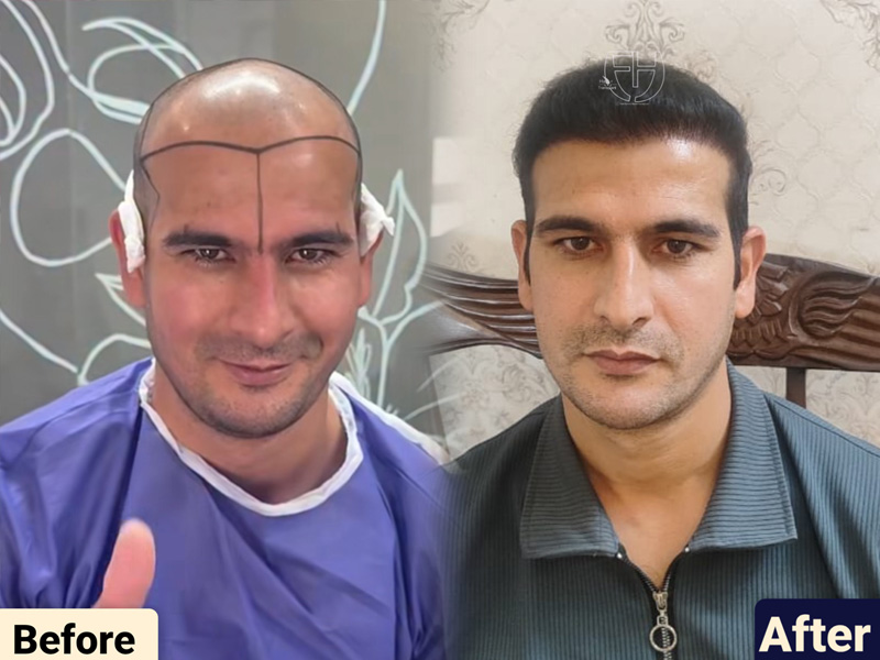 کاشت مو به روش fit