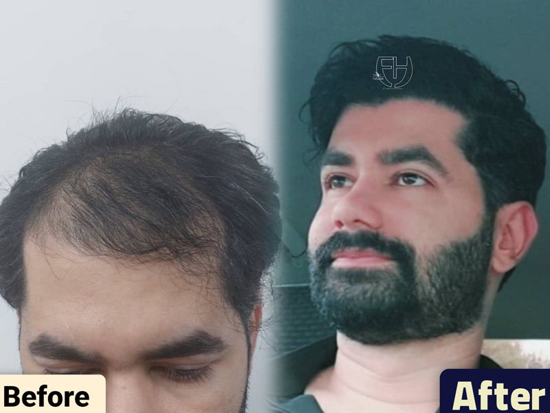 کاشت مو به روش fit و sut