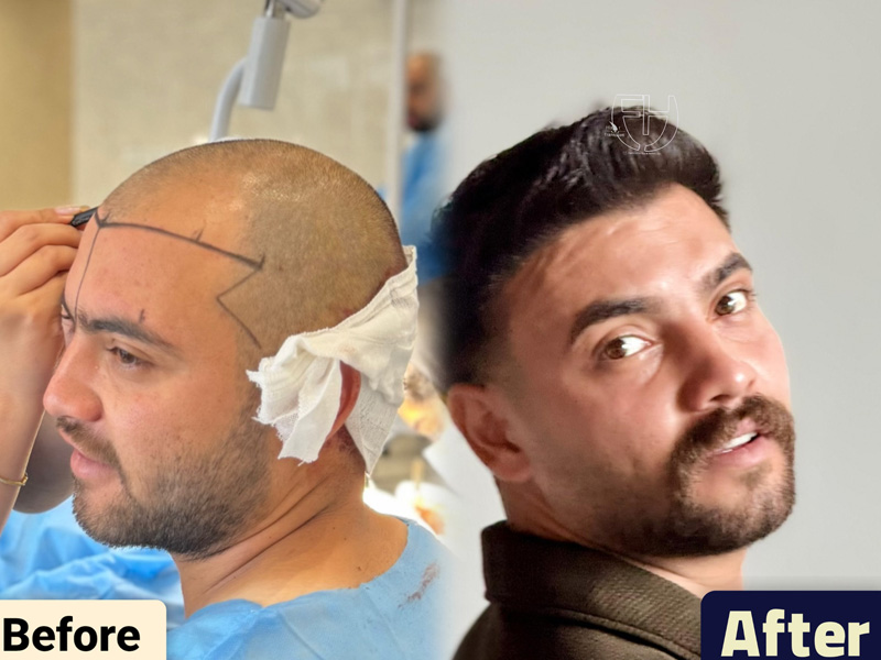 کاشت مو به روش fit و sut