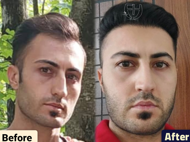 کاشت مو به روش fit و sut