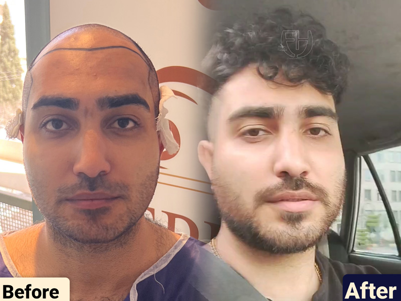 کاشت مو به روش fit