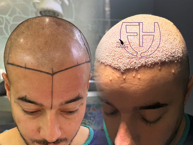 کاشت مو به روش fit