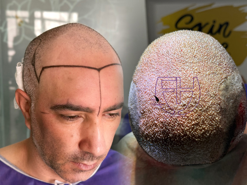 کاشت مو به روش fit و sut