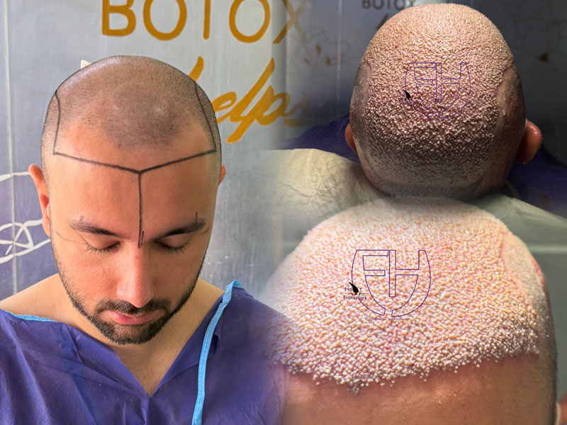 کاشت مو به روش fit