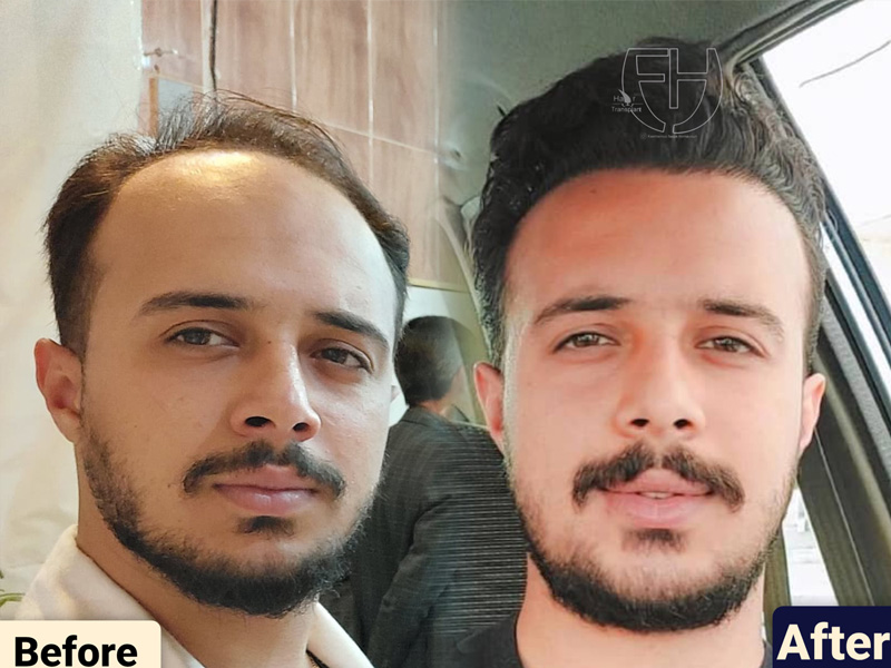 کاشت مو به روش fit و sut