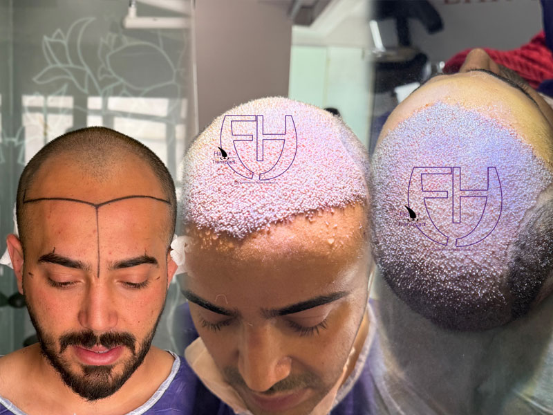 کاشت مو به روش fit