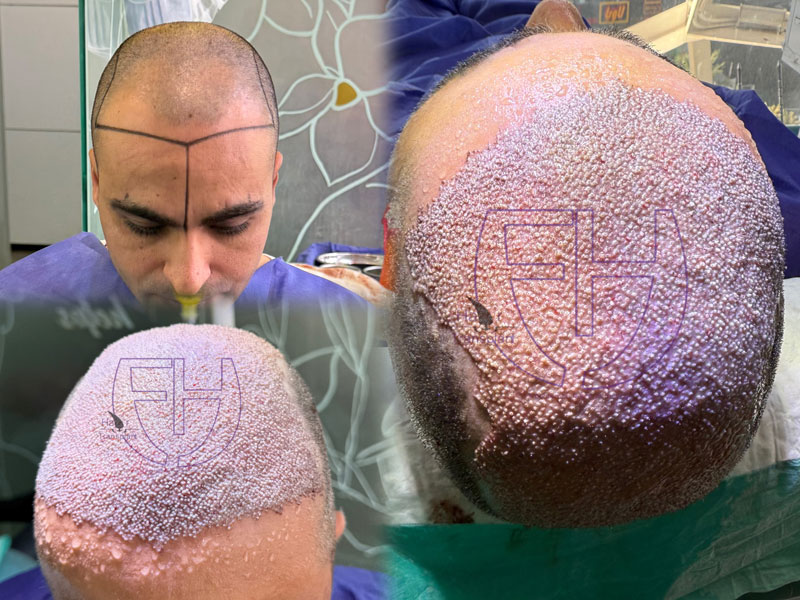 کاشت مو به روش fit و sut