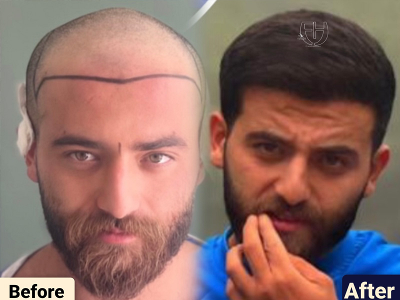 کاشت مو به روش fit