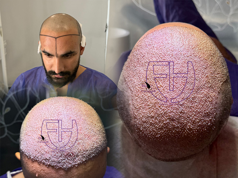 کاشت مو به روش fit