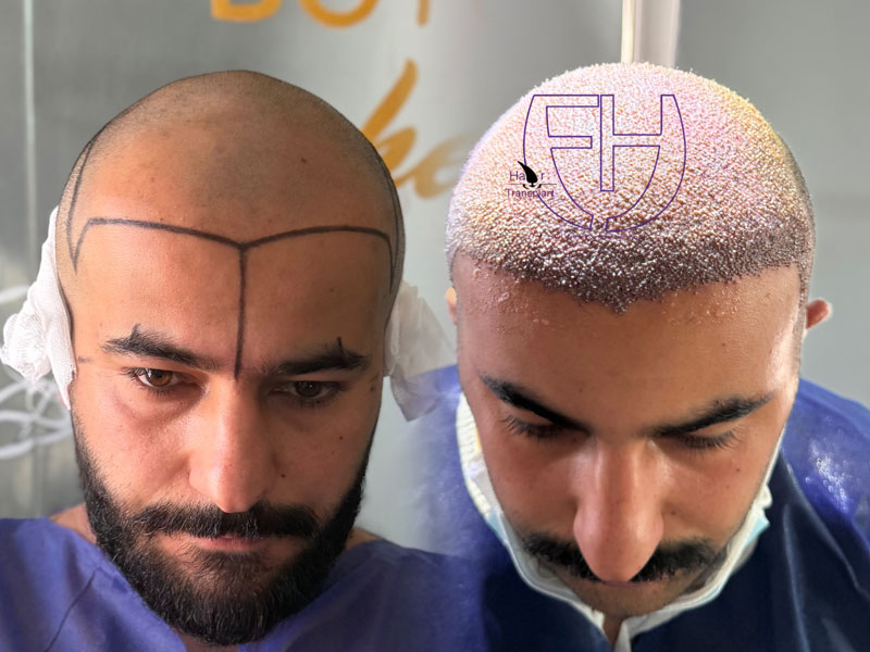 کاشت مو به روش fit و sut