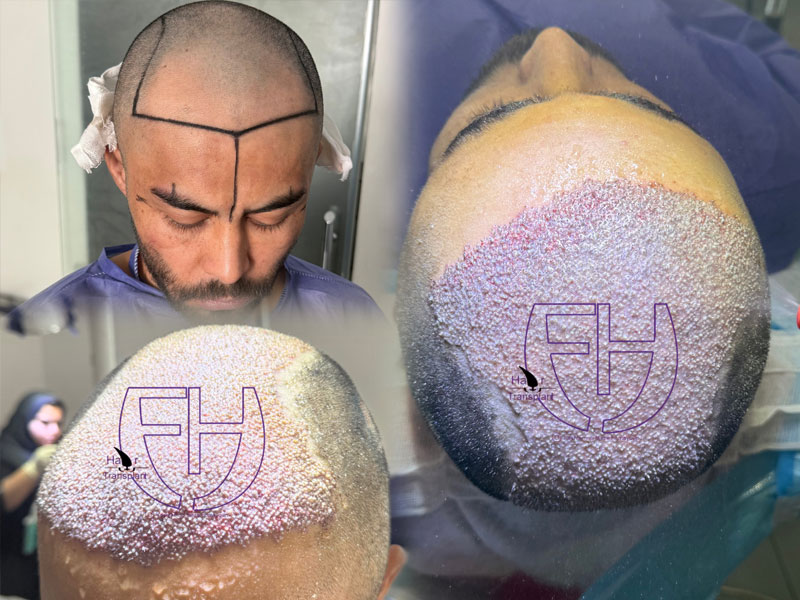 کاشت مو به روش fit و sut