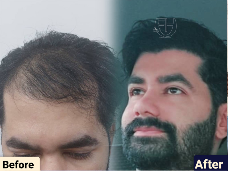 کاشت مو به روش fit و sut