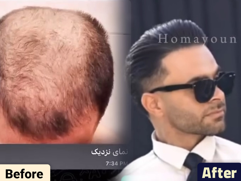 کاشت مو به روش fit