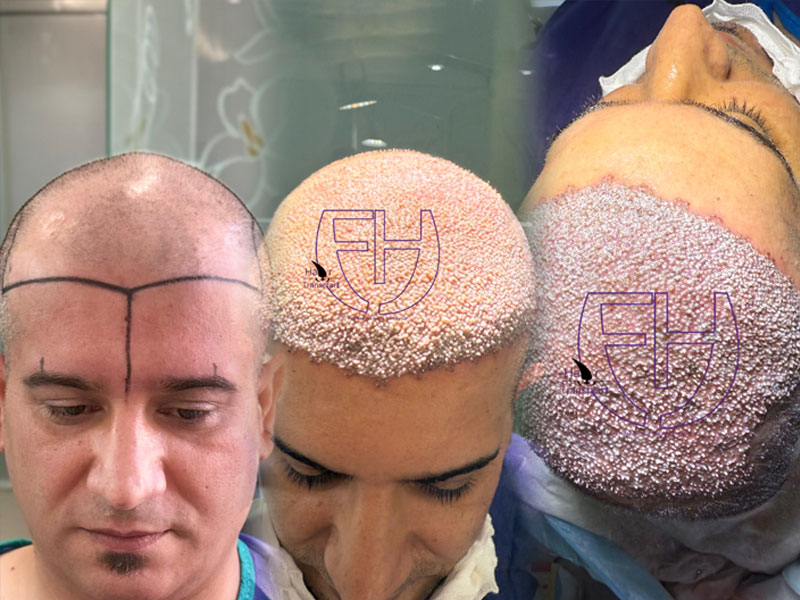 کاشت مو به روش fit