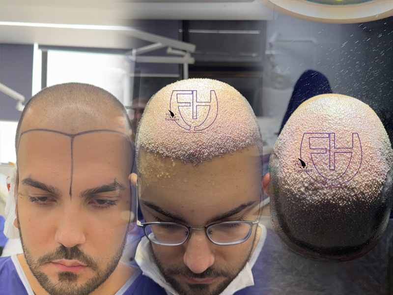 کاشت مو به روش fit