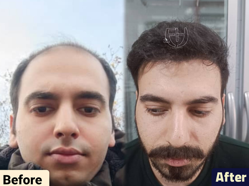 کاشت مو به روش fit