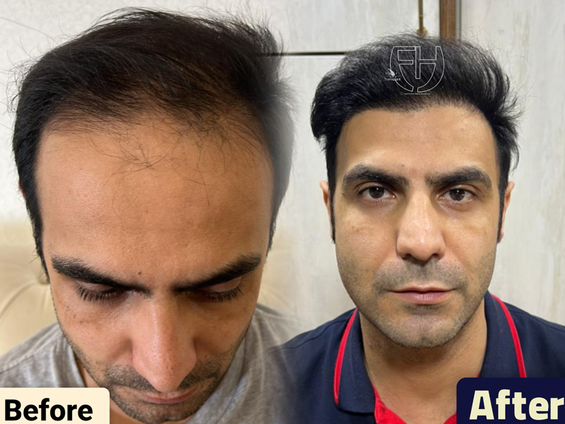 کاشت مو به روش fit